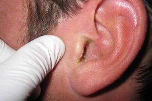 Грибок в ушах - лечение