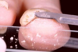 Анализ на грибок ногтей