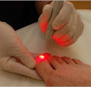 Лечение грибка ногтей лазером