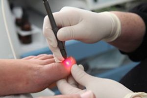 Лечение грибка ногтей лазером
