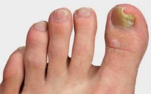 грибок ногтей на ногах лечение