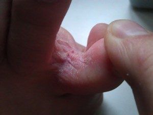 Лечить грибок между пальцами