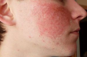 Лечение микоза кожи лица