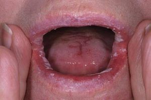 Дрожжевой грибок во рту лечение 15