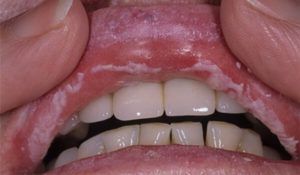 Дрожжевой грибок во рту лечение 14