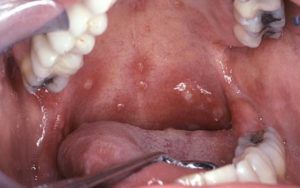 Дрожжевой грибок во рту лечение 16