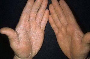 Кандидоз между пальцев рук 12