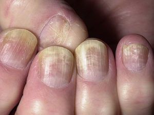 грибок ногтей лечение дома