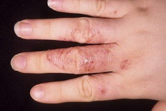 Чем лечить грибок ногтей на руках?