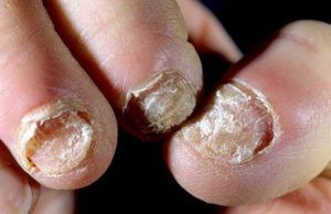 Лечение грибка ногтей запущенная форма