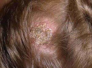 Народные средства лечения грибка кожи головы thumbnail
