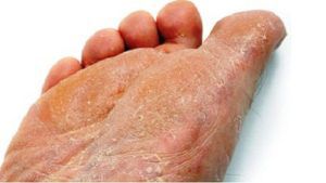 Грибок кожи ног лечение народными средствами уксус thumbnail