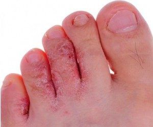 Как вылечить грибок пальцев ног thumbnail