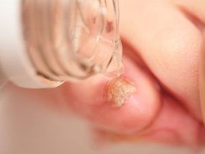 Как вылечить грибок кожи уксусом thumbnail