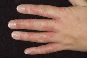 Кандидозы между пальцев лечение thumbnail