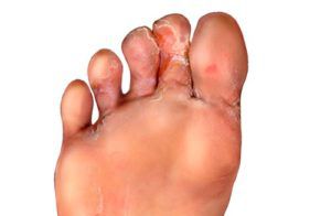 Как вылечить грибки на пальцах ног thumbnail