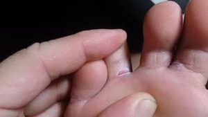 Кожа пальцев ног при грибке thumbnail