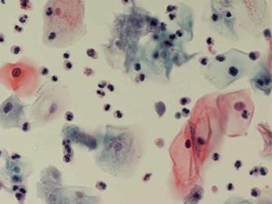 Кандидозы у женщин бактерии thumbnail