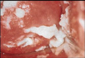 Симптомы при молочнице половых органов thumbnail