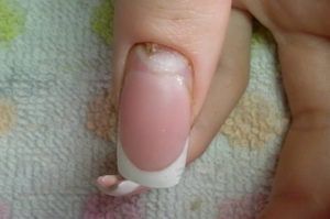 Как вылечить народным средством грибок на ногтей на руках thumbnail