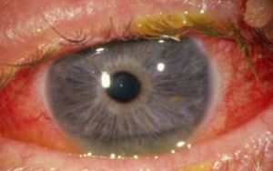 Лечение кандидоза глаз у детей thumbnail