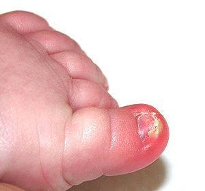 Грибок кандида на ногтях лечение народными средствами thumbnail