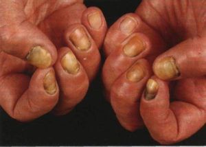 Кандидоз ногтей народное лечение thumbnail