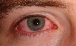 Кандида глаз лечение в домашних условиях thumbnail