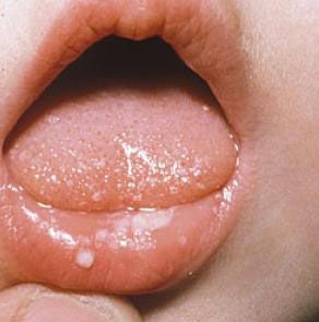 Кандидоз в уголках губ у ребенка thumbnail