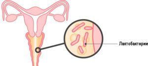 Бактериальная молочница у женщин thumbnail